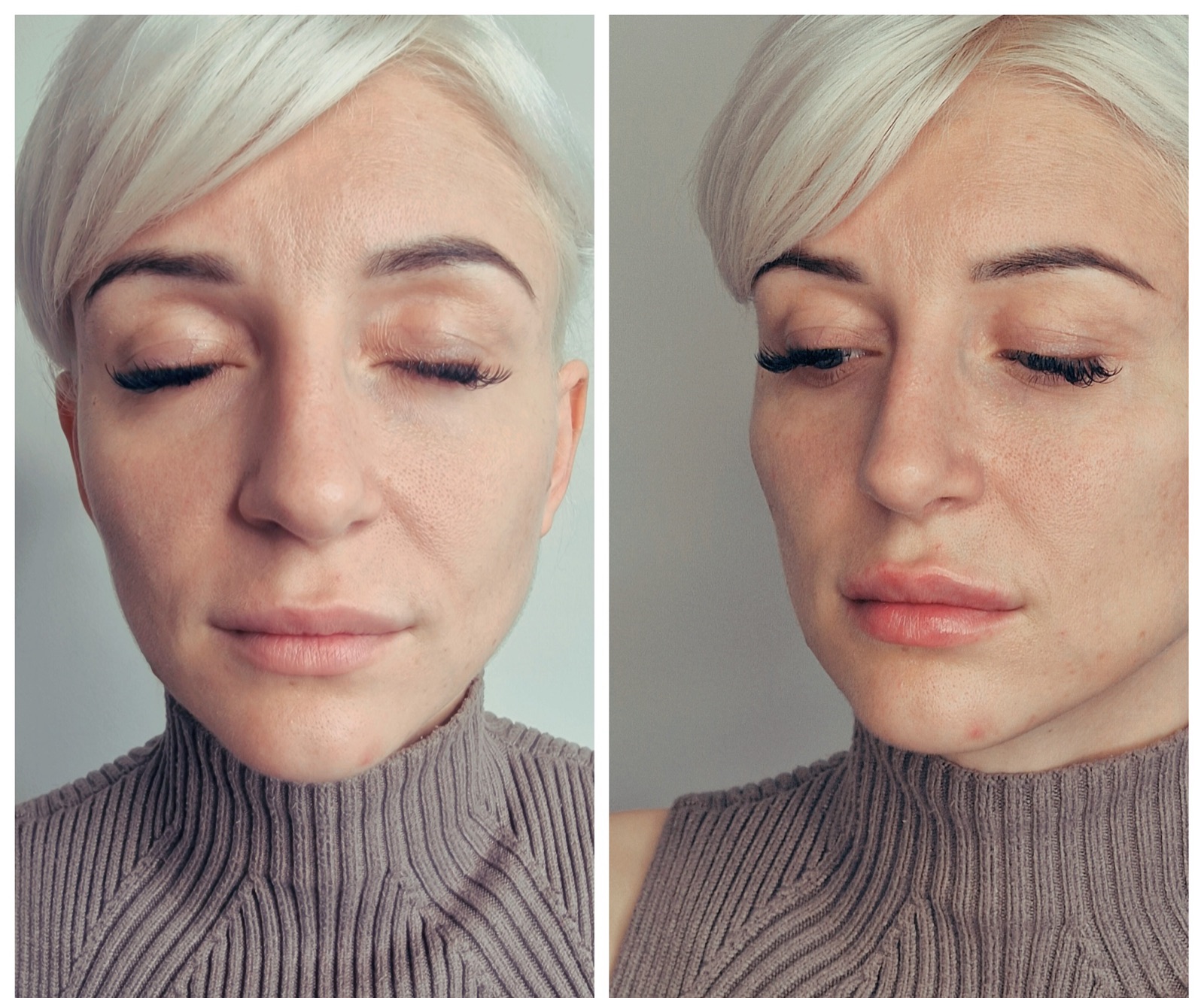 Aesthetics treatment