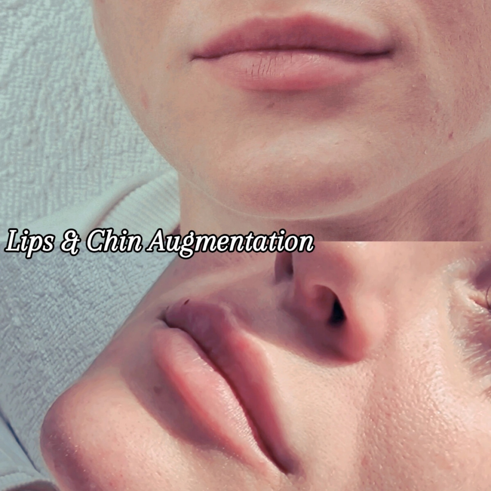Lip and chin augmentation