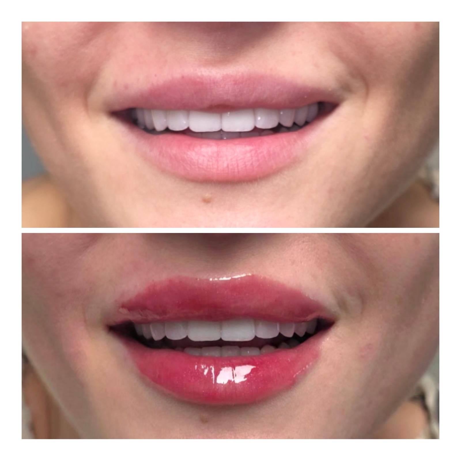 Microneedling treatment area