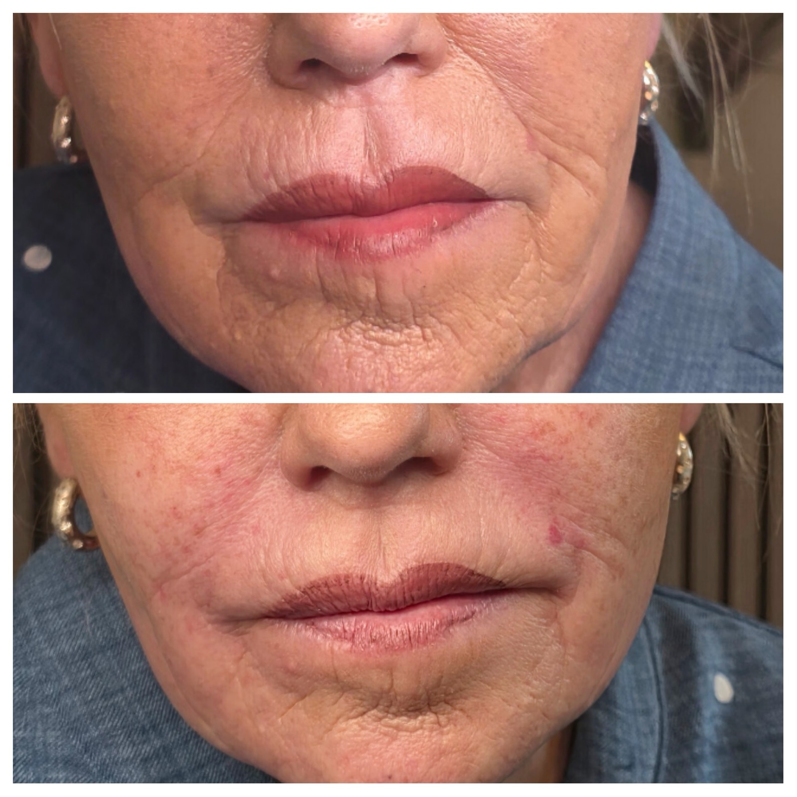 Before and after dermal filler around the mouth
