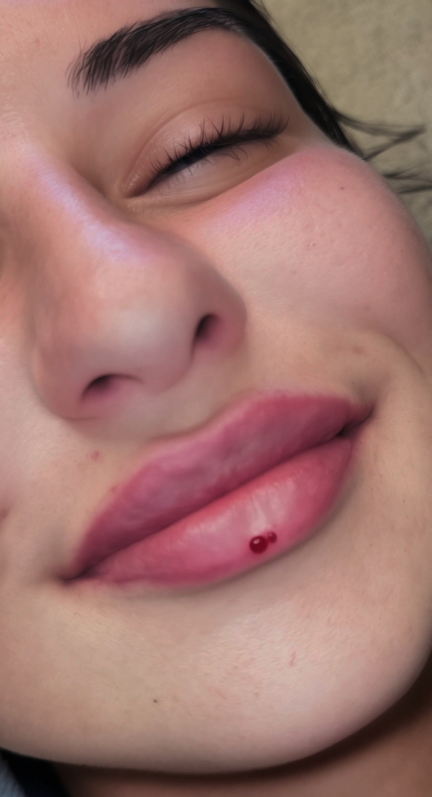 Aesthetic result